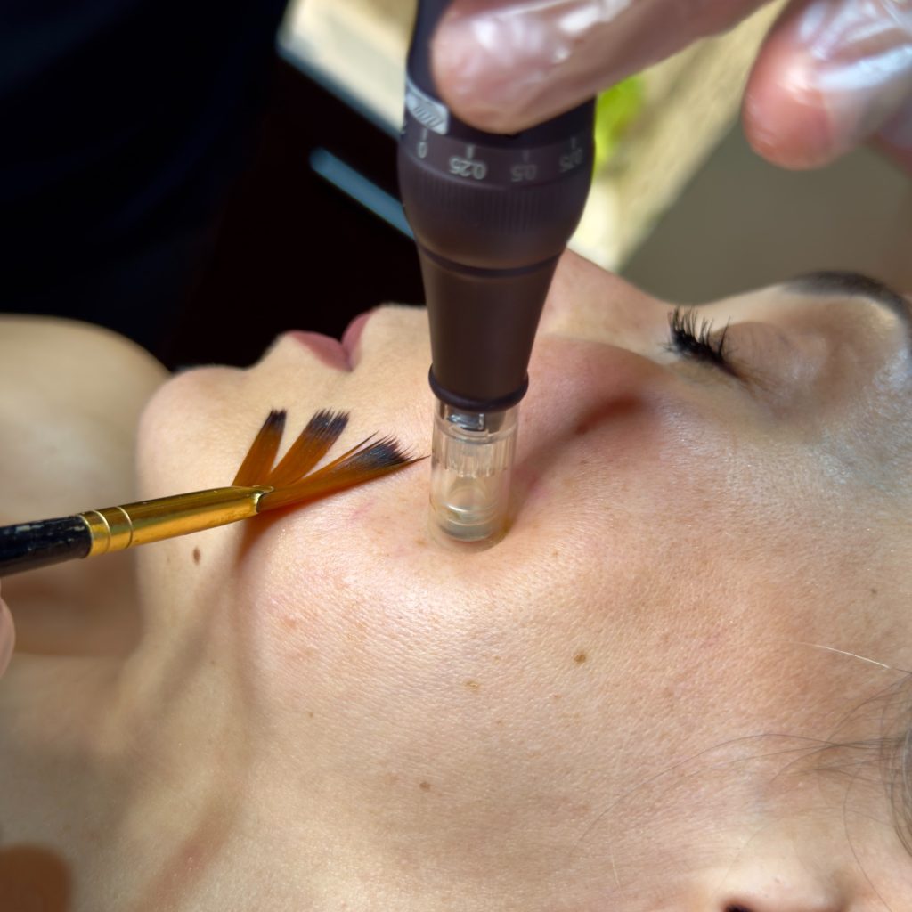 Micropunción Facial vitaminas, tensor, aclarante + Mascara led